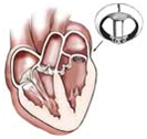 Cardiac Bypass Surgery India