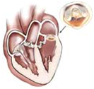 Cardiac Bypass Surgery