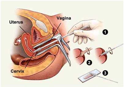 Cervical Cancer, Cervical Cancer, India Surgery Cervical Treatment