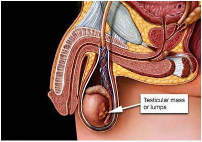 India Surgery Testicular Cancer, India Surgery Testicles, India Surgery Testicular Cancer Treatment