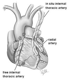 Surgery India On Pump Heart Surgery,India Cost On Pump CABG Surgery, On Pump Heart Surgery