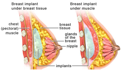 Surgery India Breast Augmentation, Cost Breast Augmentation, India Breast Augmentation Surgery Hospitals
