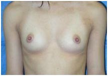 Surgery India Breast Augmentation, Cost Breast Augmentation