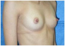 Cost Breast Augmentation, Breast Augmentation Surgery, India Breast Augmentation Surgery Hospitals