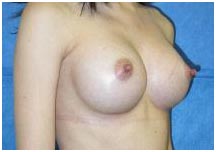 Surgery India Breast Augmentation, India Breast Lift Raises, India Breast Augmentation Surgery Hospitals