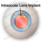 India Surgery Intraocular Lens Implant, India IOL Intraocular,Cost IOL, Intra Ocular Lens Implants Advice, Intraocular Lens Implant Treatment