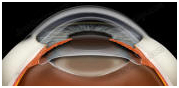 Contact Lens, Eye Operation, Intraocular Lens Implant Information, Intra Ocular Lens Implants Advice, Intraocular Lens Implant Treatment