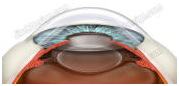 India Intraocular Lenses, Intraocular Lens Implantation, Intraocular Lenses Implantation, Eye Surgeons