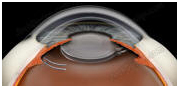 India Surgery Intraocular Lens Implant, India IOL Intraocular,Cost IOL, Intraocular Lens Implant, India Intraocular Lenses