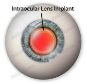 India Surgery Intraocular Lens Implant, India IOL Intraocular,Cost IOL, Intraocular Lens Implant