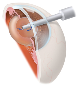India Surgery Small Incision Cataract, India Low Small Incision Surgery, Small Incision Cataract Surgery, Small Incision Cataract Surgery