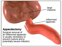Cost Appendectomy Surgery, India Surgery Appendix Appendectomy Surgery, Appendectomy Surgery