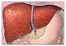 Cost Liver Cirrhosis, Liver Cirrhosis, Liver Cirrhosis Treatment, India Liver Cirrhosis