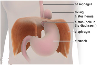 India Surgery Gastric Hiatus Hernia, Gastric Hiatus Hernia Surgery, India Hiatus Hernia