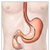 Cost Ulcer Treatment, India Ulcer Treatment, Ulcers Treatment, India Cost Gastric- Duodenal Ulcer Treatment Hospital