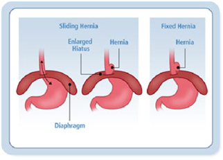 India Surgery Hiatus Hernia, Cost Hiatus Hernia Surgery, Hiatus Hernia, Hiatus Hernia, Hiatus Hernia Surgery, India Hiatus Hernia