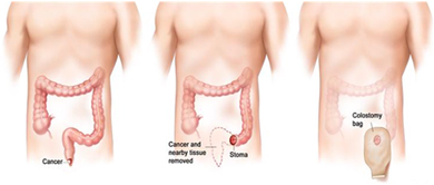 Cost Abdominal-Perineal Surgery, India Abdominal - Perineal Resection Of Rectum Surgery
