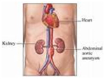 Cost Aortic Aneurysms Surgery India, Aortic Aneurysm Surgery, Aortic Aneurysm, India Aortic Aneurysm Surgery