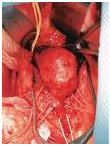 India Surgery Aortic Aneurysm, Cost Aortic Aneurysms Surgery India, Aortic Aneurysm, India Aortic Aneurysm Surgery