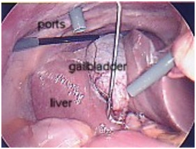 Cost Cholecystectomy Gall Bladder, Laparoscopic Cholecystectomy