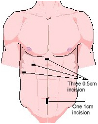 India Surgery Cholecystectomy, Cholecystectomy Gall Bladder Removal Surgery