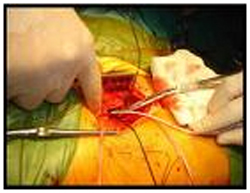 India Surgery Femoral Embolectomy, India Femoral Embolectomy Surgery, India Femoral Embolectomy