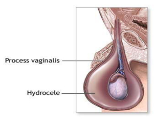 India Surgery Hydrocele, Cost Hydrocele Surgery, Hydrocele Surgery