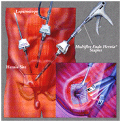 India Surgery Hernia, Cost Hernia Surgery India, Laparoscopic Hernia Surgery, India Surgery Hernia