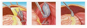 Cost Minimally Invasive Gallbladder, Gall Bladder Removal, India Gall Bladder