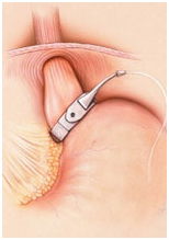 India Surgery Gastric Banding,Cost Gastric Banding Surgery Hospital, Gastric Banding Surgery