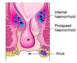 Surgery India Hemorrhoidectomy,Cost Hemorrhoidectomy Surgery, Hemorrhoidectomy Surgery, Excision, India Hemorrhoidectomy