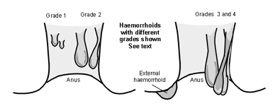 Cost Hemorrhoidectomy Surgery, India Hemorrhoidectomy, India Hemorrhoid Surgery