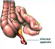 India Surgery Laparoscopic Appendectomy, Cost Lap Appendectomy Surgery, India Laparoscopic Surgery Training