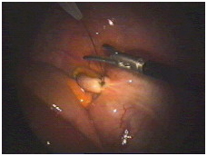 India Surgery Laparoscopic Appendectomy, India Laparoscopic Abdominal Surgery Gurgaon