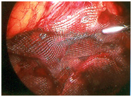 India Surgery Laparoscopic Hernia Repair, Cost Inguinal Hernia Repair, India Abdominal Endoscopy