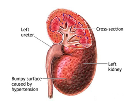India Surgery Renal Hypertension Treatment,Cost Renal Hypertension, Renal Hypertension Treatment India