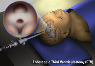 India surgery Ventriculostomy, India Cost Ventriculostomy Surgery