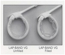 India Surgery Laparoscopic Banding, Cost Lap Band Surgery, Laparoscopic Banding Surgery Laparoscopic