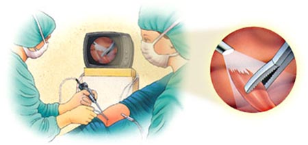 Cost Knee Arthroscopy Surgery, Arthroscopy Surgery, India Arthroscopic Surgery