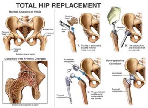 India Surgery Cemented Total Hip Replacement, Cost Cemented Total Hip