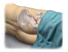 best hip replacement surgeons