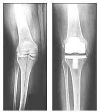 knee replacement surgery procedure