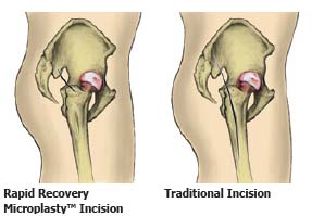 India Surgery Minimally Invasive Hip Replacement, India Cost Minimally Invasive