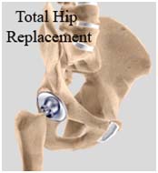 India Surgery Minimally Invasive Hip Resurfacing, MI Hip Resurfacing