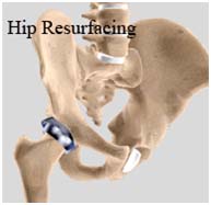 MI Hip Resurfacing, Minimally Invasive Hip Resurfacing Surgery