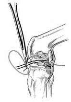 India Surgery PCL Reconstruction, India Cost Anterior Cruciate Ligament, PCL Reconstruction Surgery