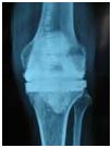 India Surgery Revision Knee Replacement, Repeat Knee Replacement, India Revision Surgery, Knee Revision Treatment