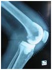 India Surgery Revision Knee Replacement, Knee Revision Treatment, India Surgery Tour