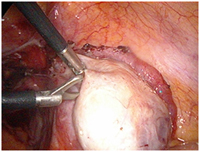 India Surgery Total Cystectomy, Cost Total Cystectomy Surgery Hospital
