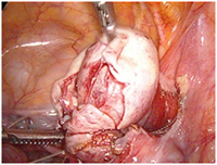 India Surgery Total Cystectomy, Total Cystectomy Surgery, India Cost Total Cystectomy Surgery